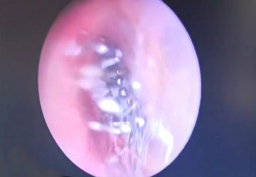 Un médecin trouve une araignée à l'intérieur de l'oreille de sa patiente