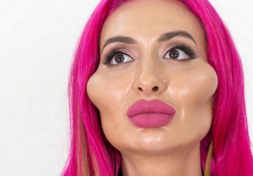 joues record monde femme opérations chirurgie avant après
