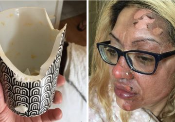 Son visage finit totalement brûlé après le test d'une astuce TikTok