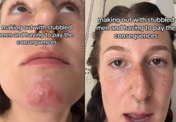 barbe jeune femme peau