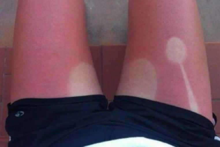 top pires coups de soleil insolites photos (8)