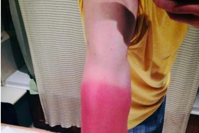 top pires coups de soleil insolites photos (8)