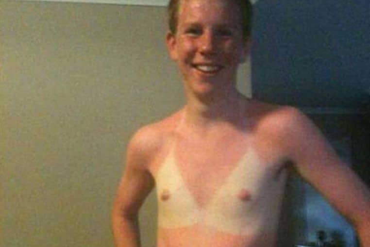 top pires coups de soleil insolites photos (8)