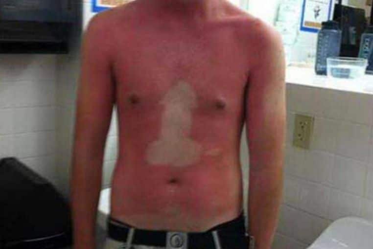 top pires coups de soleil insolites photos (8)