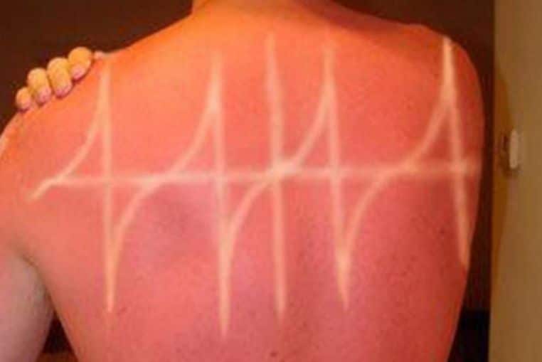 top pires coups de soleil insolites photos (8)