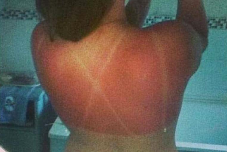 top pires coups de soleil insolites photos (8)