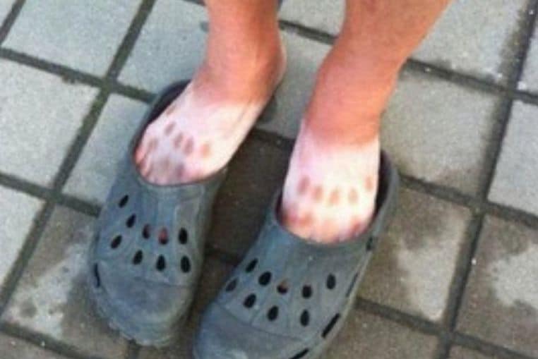 top pires coups de soleil insolites photos (8)