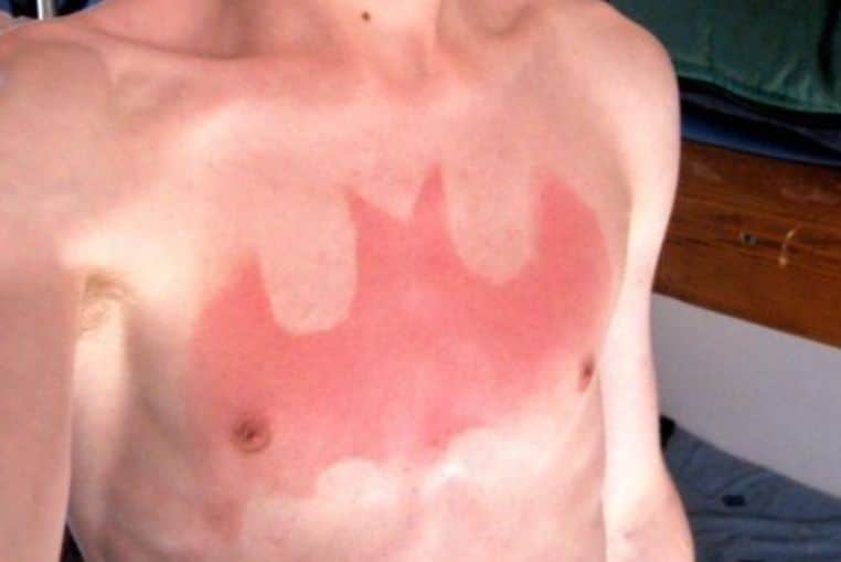 top pires coups de soleil insolites photos (8)