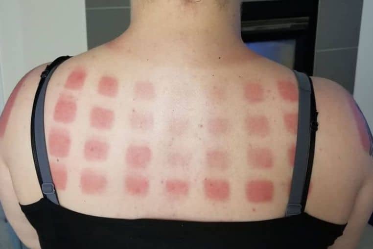 top pires coups de soleil insolites photos (8)