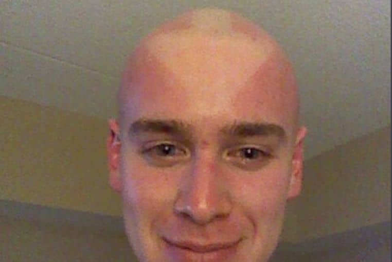 top pires coups de soleil insolites photos (8)