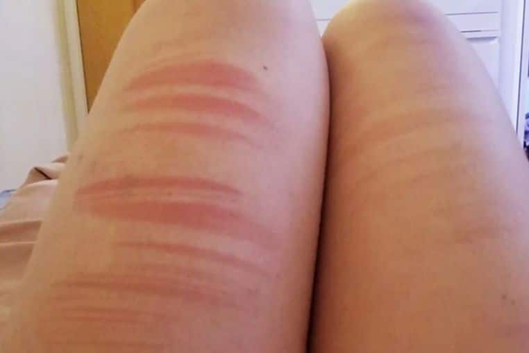 top pires coups de soleil insolites photos (8)