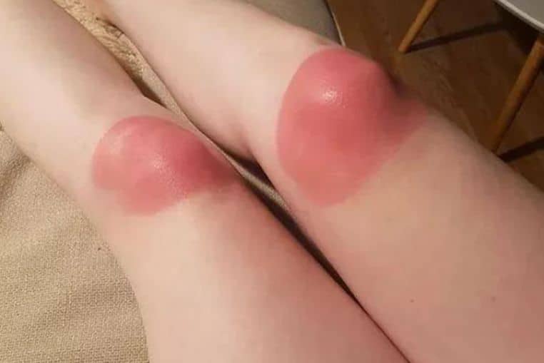 top pires coups de soleil insolites photos (8)