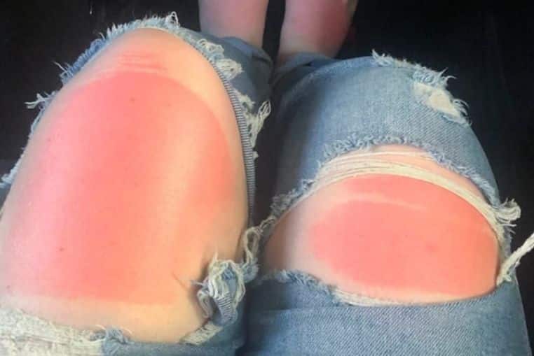 top pires coups de soleil insolites photos (8)