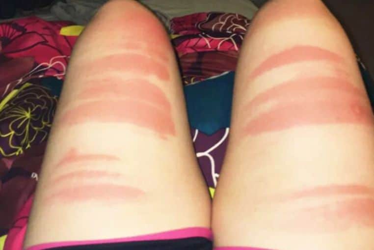 top pires coups de soleil insolites photos (8)