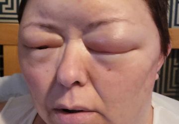 allergie coloration loreal