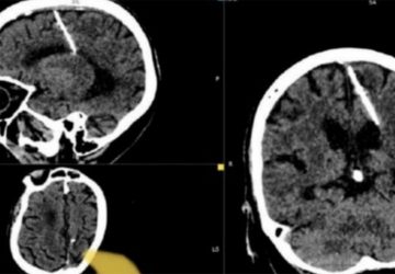 cerveau femme aiguille insolite santé médecine info