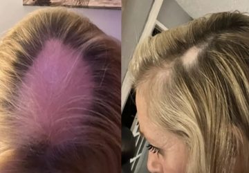 Femme perd ses cheveux
