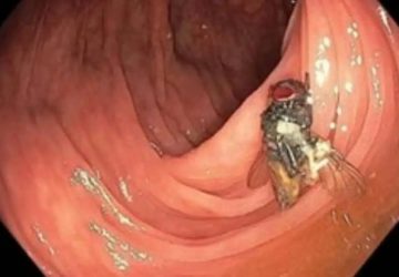 Mouche dans un colon