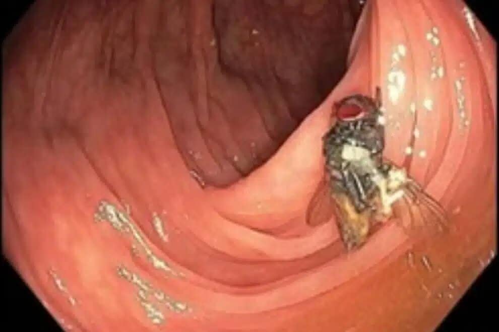 Mouche dans un colon