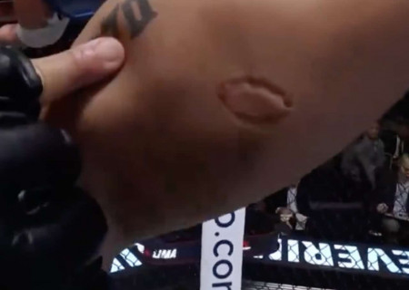 UFC morsure