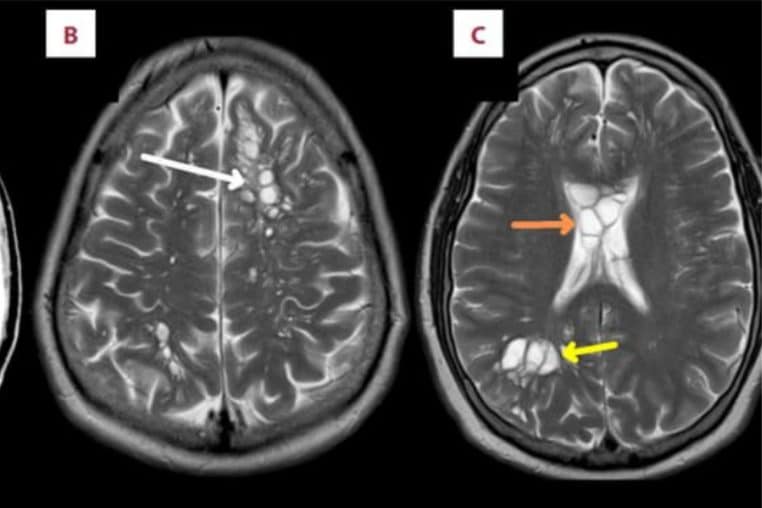 vers cerveau larves tenia (2)