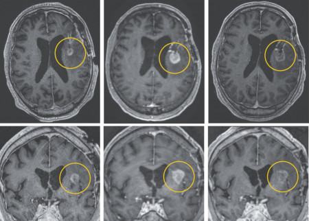 cancer cerveau 3