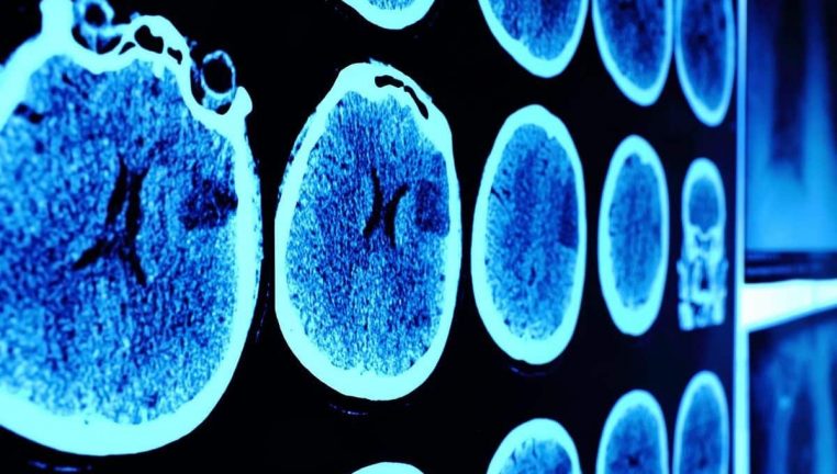 cancer cerveau