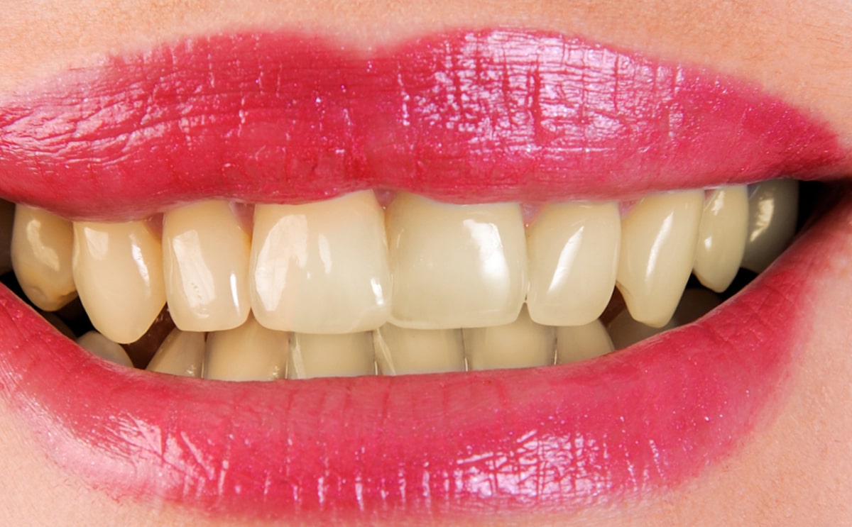 Un dentiste offre quelques astuces pour ne pas avoir les dents jaunes