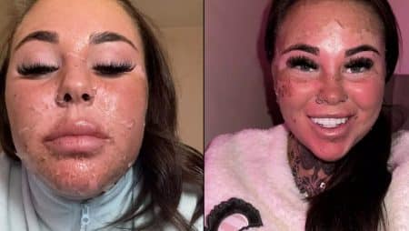 Influenceuse Natalia Armstrong visage brule