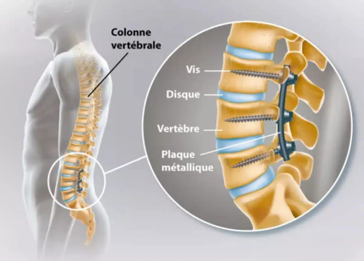 22 Christine Bravo sante dos arthrodèse