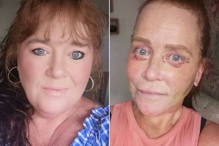 Femme chirurgie avant apres