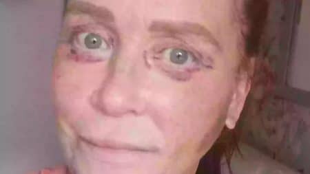 Femme chirurgie ratee yeux