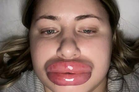 Femme levres gonfle cinq fois