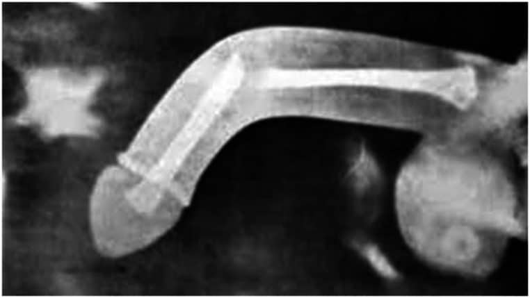 Medecin fracture penis
