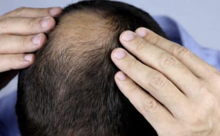 cheveux IST info