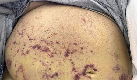 Deux hommes gravement infectés par des vers parasites après une greffe
