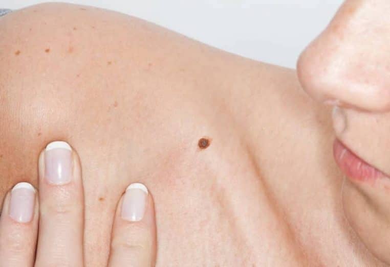 melanome diagnostic pire jamais vu