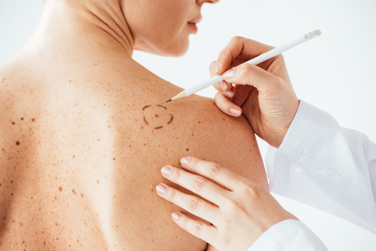 melanome diagnostic pire jamais vu