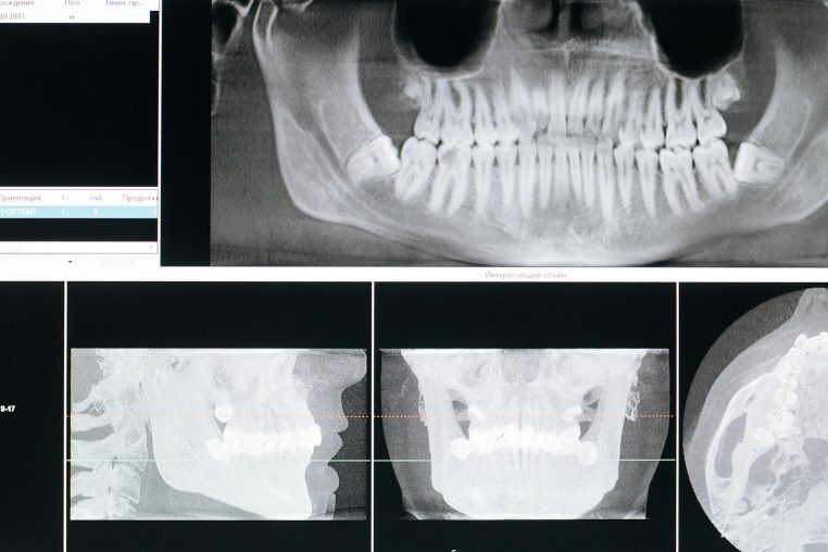 Detail image of a panoramic dental X-ray, showing teeth and jaw structure.