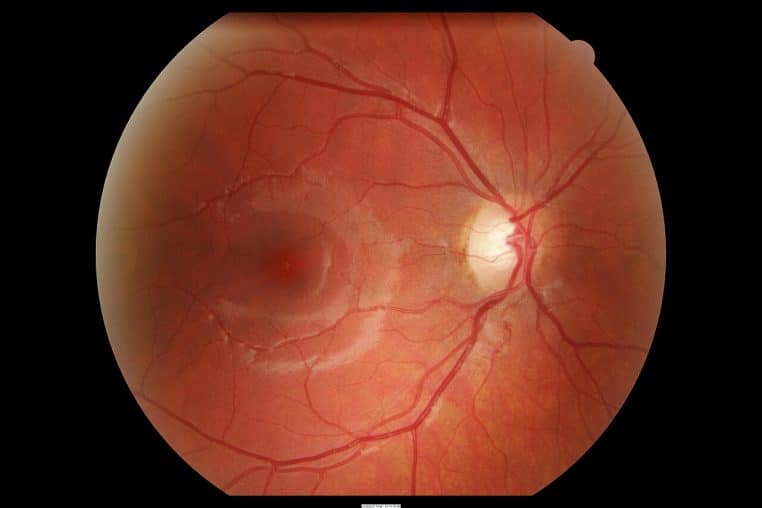 Fond d’œil normal montrant le nerf optique et les vaisseaux rétiniens.