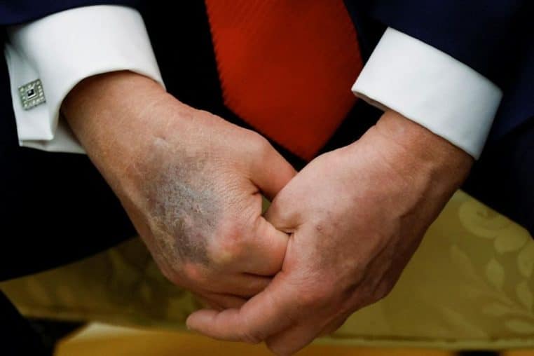 donald trump mains soucis de sante