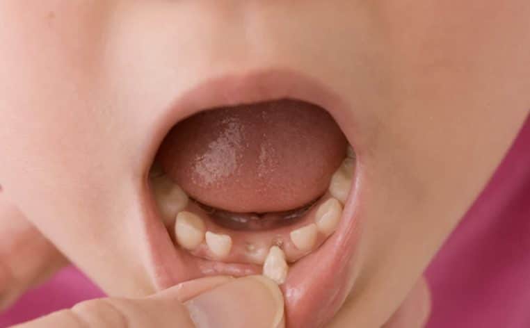 enfant dent qui bouge actu