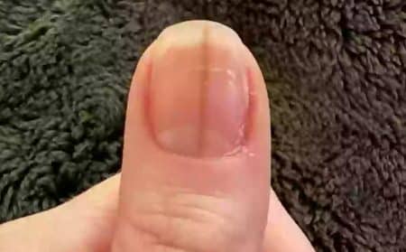 ongle santé