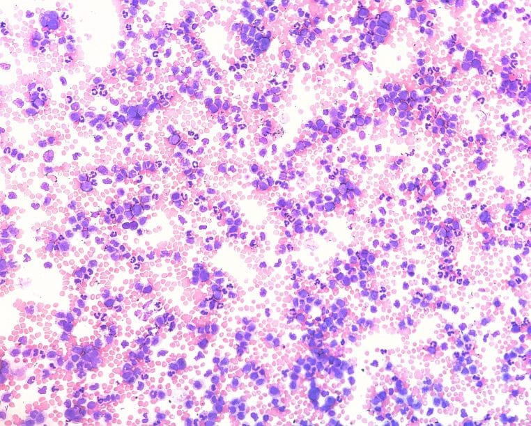 Image microscopique d’un frottis sanguin pathologique