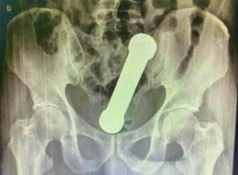 Un homme se coince un altère dans le derrière