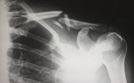 Fracture osseuse