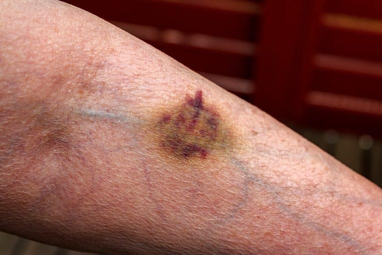 Hématome sur l’avant-bras d’une femme âgée après une prise de sang, illustrant la surveillance biologique après 60 ans.