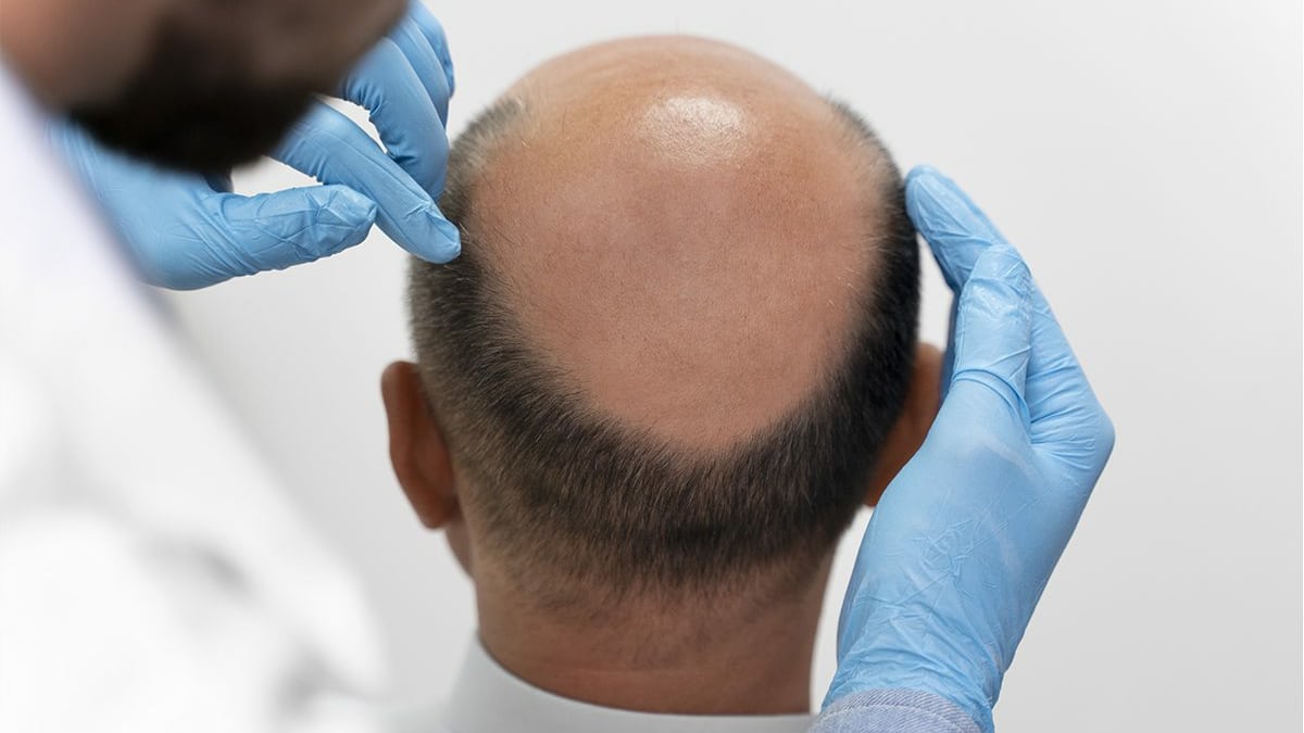 Calvitie Caracteristiques