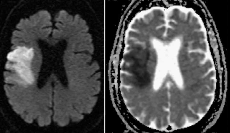 IRM DWI/ADC avec hyperintensité compatible infarctus