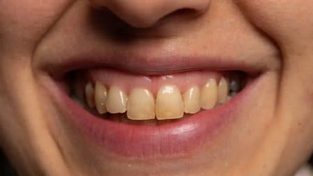 Dents Jaunes Causes